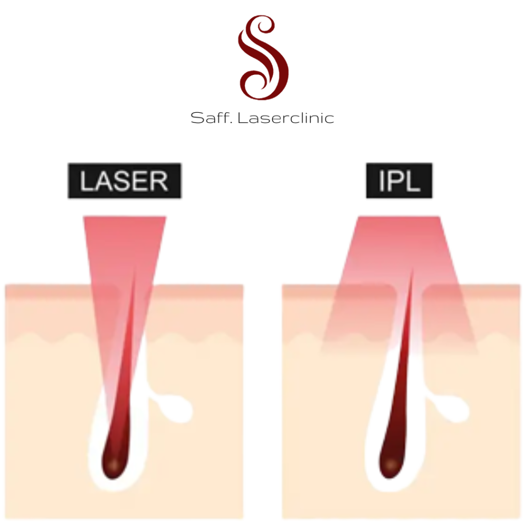 Saff. Laserclinic - Laserkliniek, Diode ice laser, vrijwel pijnloos, in Houten