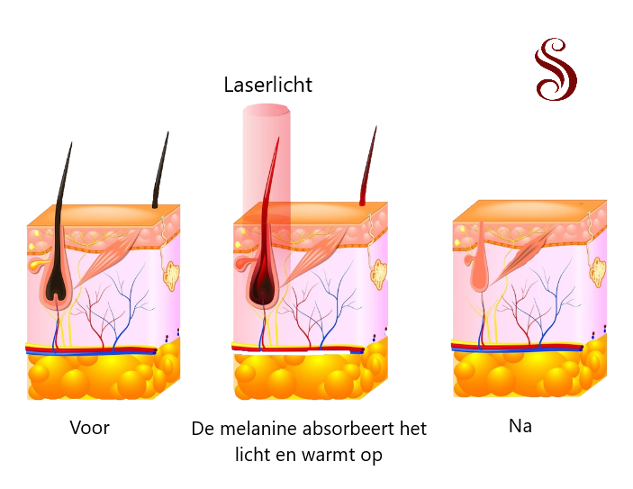 Saff. Laserclinic - Laserkliniek, Diode ice laser, vrijwel pijnloos, in Houten